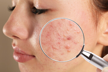 Teenage girl with acne problem visiting dermatologist, closeup. Skin under magnifying glass