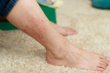 Yellow people have leg allergies, leg skin problems