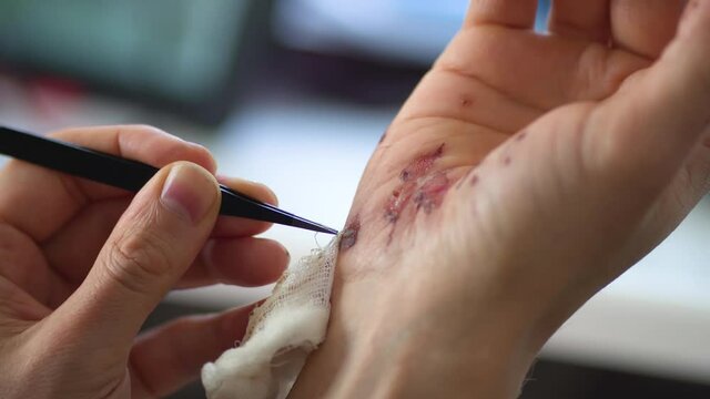 Man cleaning a bleeding wound under the skin after the accident.Traumatic pain of a hand. Treatment and disinfection of deep wounds.