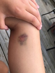 Black and blue bruise contusion on child's leg