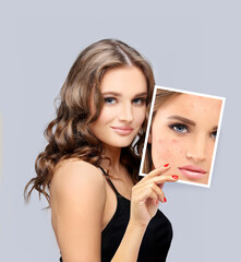 Post-Acne Marks /Treating Acne Scars.Acne Scar Removal	