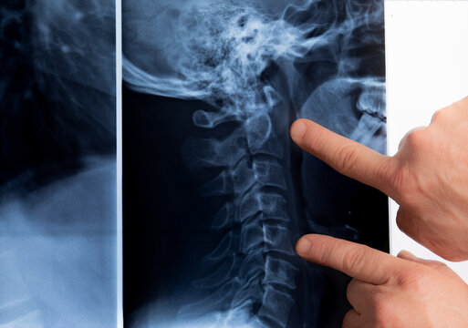 Neck xray close up with doctor hands pointing