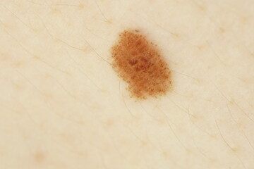 Macro closeup of a freckled mole seen with a polarized dermatoscope 
