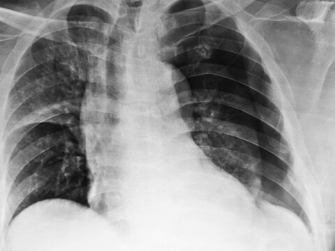 chest x ray  with tension Pneumothorax