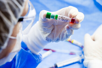 Hiv and aids infection test, doctors face and hand holding tube with blood on the blue background.