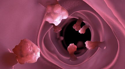 Close-up view of intestinal polyps and diseased intestinal tissue that can cause cancer - 3d illustration - obrazy, fototapety, plakaty