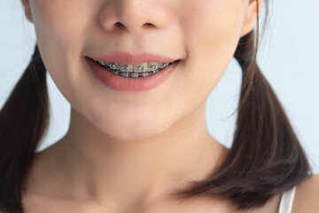 happy woman smiling with teeth braces or orthodontics dental braces, cosmetic dental care concept