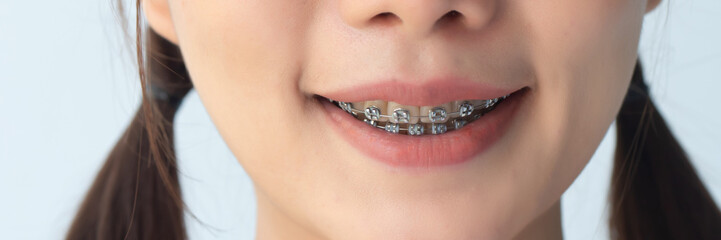 happy woman smiling with teeth braces or orthodontics dental braces, cosmetic dental care concept, banner format