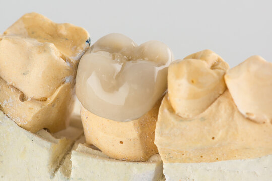 metal ceramic dental crown photographed close-up