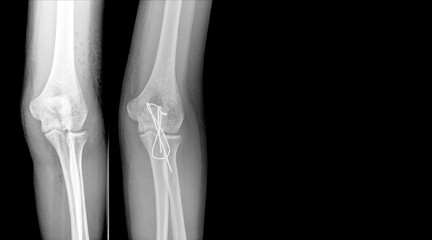 X-ray elbow showing fracture (proximal Ulna or Olecranon fracture) treated by surgery with tension band wiring fixation(TBW). Highlight on medical instrument.Medical healthcare concept.