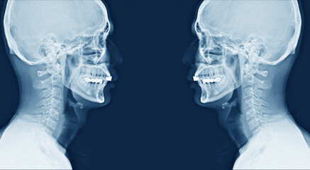 X-ray image of cervical vertebrae spine, part of vertebral column.Side view