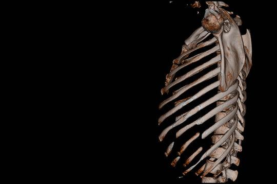 CT Scan Thoracic spine 3D finding The film shown thoracolumbar fracture injury after fall form height .