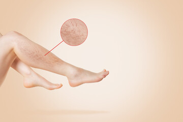 Smooth female legs, with varicose veins on the lower leg. Zoomed image of varicose. Beige...