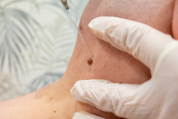 removing moles. men's cosmetic operations. anesthetic injection anesthesia before the mole removal