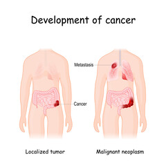 Cancer development. colon cancer and metastasis in lungs - obrazy, fototapety, plakaty