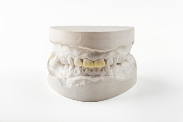 Stomatologic plaster cast, molds of human jaws and teeth on white background. Dental casting gypsum for manufacture of dentures, braces or false teeth. Dentistry and orthodontics concept. © Elena
