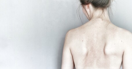Young woman turned away to white wall, showing unhealthy back with scapular winging. Caucasian naked female with brown hair. Health care of spine, back and shoulder blades. Check up at hospital clinic - obrazy, fototapety, plakaty