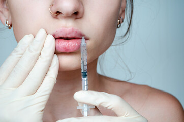 
Beautiful woman with a bruise on her lips after lip augmentation with hyaluronic acid. Injection...