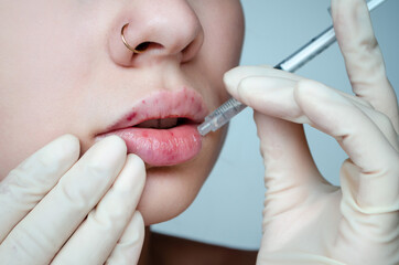 
Beautiful woman with a bruise on her lips after lip augmentation with hyaluronic acid. Injection...