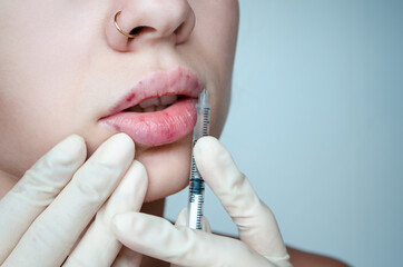 
Beautiful woman with a bruise on her lips after lip augmentation with hyaluronic acid. Injection...