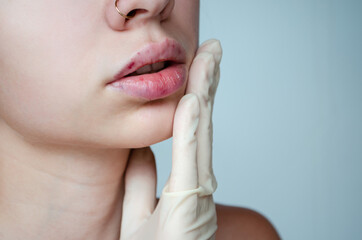 
Beautiful woman with a bruise on her lips after lip augmentation with hyaluronic acid. Injection...