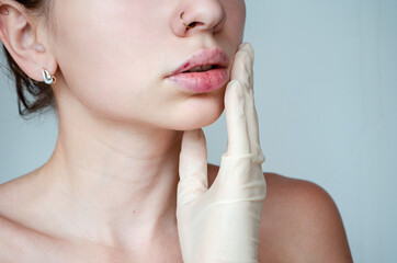 
Beautiful woman with a bruise on her lips after lip augmentation with hyaluronic acid. Injection...