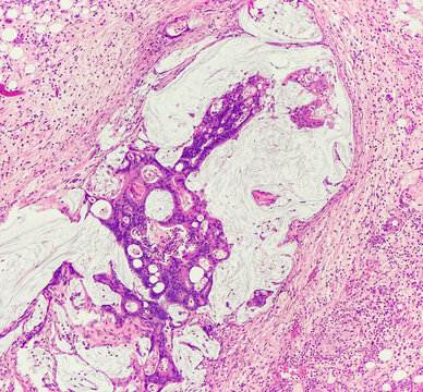 Colon carcinoma with mucin producing. It shows tumor clusters in mucin lake, photo under microscope