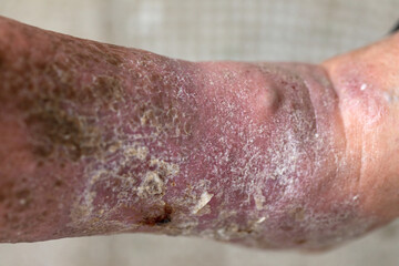 Foot ulcer