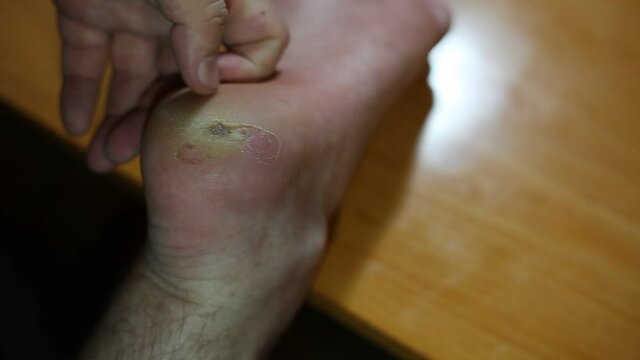 Damage to the heel of the foot after wearing shoes. Big blister. Wound caused by new shoes.