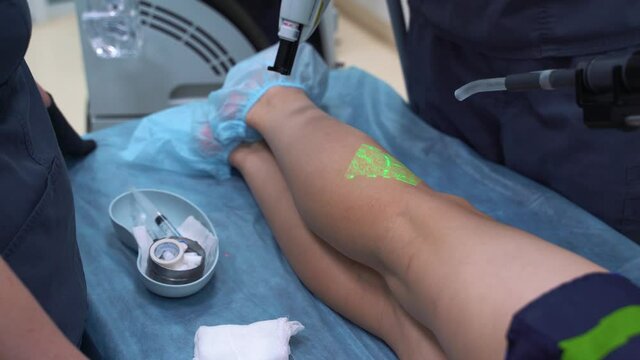 Sclerotherapy is one method for the treatment of spider veins, occasionally varicose veins, and venous malformations.V aricose, Sclerotherapy and Vein Viewer