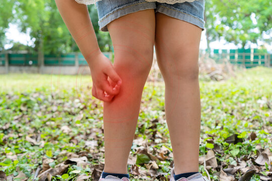 Asian girl has allergies with mosquitoes bite and itching her leg. Repellent, Dengue virus, Yellow fever, West nile, Malaria, Diseases Spread by Mosquitoes concept