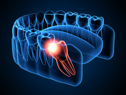 3d render of jaw x-ray with wisdom mesial impaction