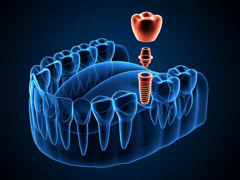 3d render of jaw x-ray  with dental implant placement