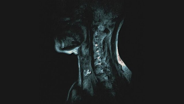 Bulk multicolored MRI of the cervical spine, detection of protrusions and hernias