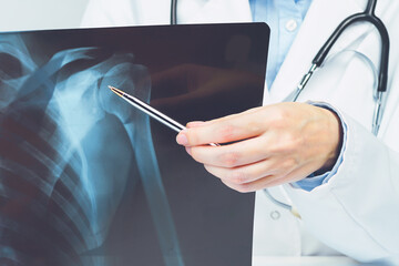 Female doctors hand pointing at x-ray medical imaging with a shoulder condition. Bone health,...