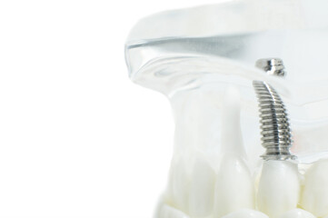 Artificial jaw with teeth and screwed implants on a white background, copy space. Modern dentistry