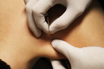 Dry Needling Dry Needling