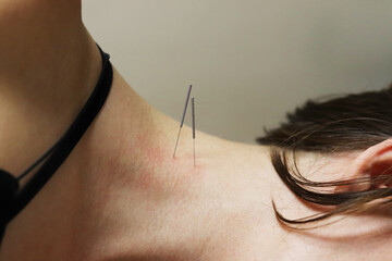Superficial dry needling for scalene muscles.