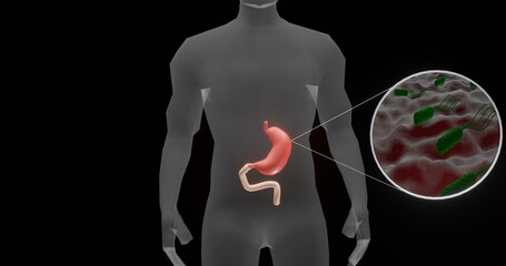 Stomach infection by Helicobacter pylori in 3d illustration