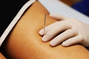 Holding the needle in site during dry needling.
