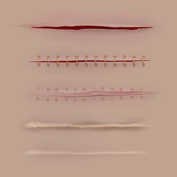 Surgical Sutures Healing Stages. Realistic Bloody Wound And Stitch. Scars, Stitched Gash Different Curing Steps, Medicine Vector Set