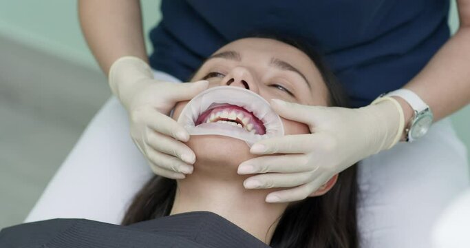 Female dentist in medical white latex gloves puts rubber dam on a patient in a dental clinic. Cleaning teeth. Modern dental office
