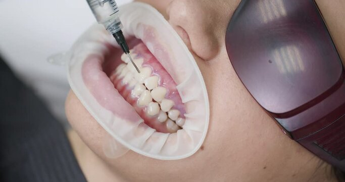 Young woman with an expander in mouth at the dental clinic. Beautiful smile. The health of teeth. Dentist stomatologist whitening teeth for patient in medicine dental clinic
