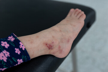 dermatitis on leg of children , mosquito bite make dermatitis , rash allergy and scar on skin