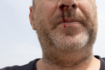 Obraz premium Nosebleed , an old man with a bloody nose. Healthcare and medical concept.