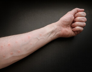 Marks from an allergy test on a hand.