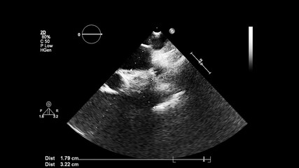 Image of the heart in gray-scale mode during transesophageal ultrasound.