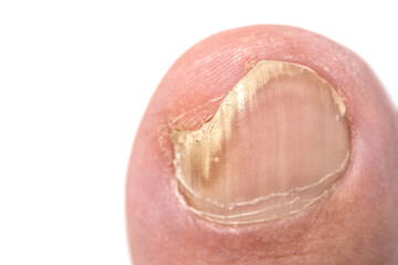 Toenail fungus close up with a human foot isolated on white background