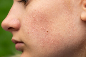 Problematic skin. Acne and red festering pimples on the face of a young girl. Facials for teen...
