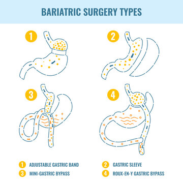 Types Of Bariatric Surgery Weight Loss Procedures- Gastric Bypass, Sleeve Gastrectomy, Adjustable Gastric Band. Stomach Medical Diagram Infographics In Line Style. Vector Illustration.